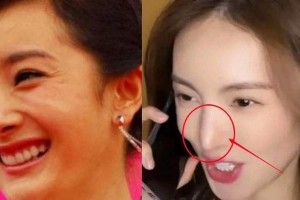 女明星动鼻子后遗症：杨幂车晓鼻孔外翻，鞠婧祎鼻梁透光